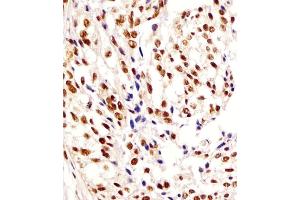 (ABIN6244112 and ABIN6578296) staining HNRNL2 in human breast carcinoma tissue sections by Immunohistochemistry (IHC-P - paraformaldehyde-fixed, paraffin-embedded sections).