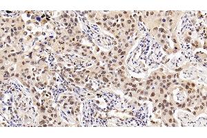 Detection of HDAC1 in Human Lung cancer Tissue using Monoclonal Antibody to Histone Deacetylase 1 (HDAC1) (HDAC1 抗体  (AA 1-482))