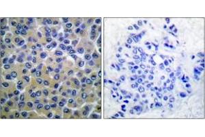Immunohistochemistry analysis of paraffin-embedded human breast carcinoma, using SYK (Phospho-Tyr348) Antibody.