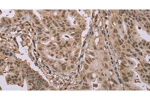 Immunohistochemistry of paraffin-embedded Human gastric cancer using CAB39 Polyclonal Antibody at dilution of 1:50 (CAB39 抗体)