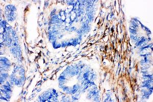 Anti- Caveolin-2 picoband antibody,IHC(P) IHC(P): Human Intestinal Cancer Tissue (Caveolin 2 抗体  (AA 1-162))