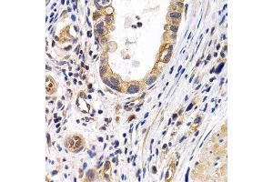 Immunohistochemistry of paraffin-embedded human stomach cancer using PTGIR antibody at dilution of 1:200 (400x lens). (Prostacyclin Receptor 抗体)