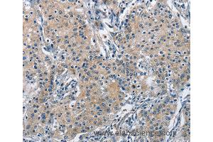 Immunohistochemistry of Human gastric cancer using TRIP4 Polyclonal Antibody at dilution of 1:50 (TRIP4 抗体)