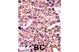 Formalin-fixed and paraffin-embedded human cancer tissue reacted with CDKN1A (phospho T145) polyclonal antibody  which was peroxidase-conjugated to the secondary antibody followed by AEC staining. (p21 抗体  (pThr145))