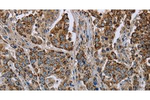 Immunohistochemistry of paraffin-embedded Human liver cancer using GOT2 Polyclonal Antibody at dilution of 1:50 (GOT2 抗体)