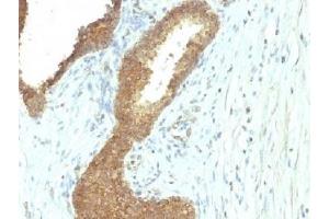 IHC testing of FFPE human colon carcinoma with Alkaline Phosphatase antibody (ALPL/597). (Alkaline Phosphatase 抗体)