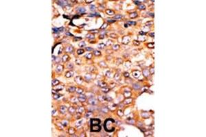 Formalin-fixed and paraffin-embedded human cancer tissue reacted with the primary antibody, which was peroxidase-conjugated to the secondary antibody, followed by AEC staining. (PANK3 抗体  (AA 150-181))