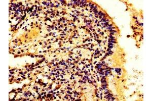 IHC image of ABIN7155213 diluted at 1:300 and staining in paraffin-embedded human lung cancer performed on a Leica BondTM system. (HMGB3 抗体  (AA 1-103))