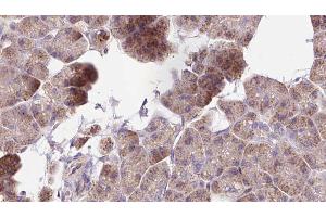ABIN6273266 at 1/100 staining Human pancreas cancer tissue by IHC-P. (MAP1B 抗体  (Internal Region))