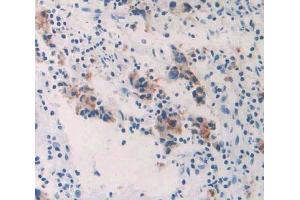 IHC-P analysis of prostate gland cancer tissue, with DAB staining. (GALC 抗体  (AA 375-535))