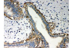 Anti- LYRIC Picoband antibody,IHC(P) IHC(P): Human Mammary Cancer Tissue (MTDH 抗体  (AA 101-270))