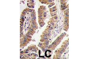 Formalin-fixed and paraffin-embedded human lung carcinoma tissue reacted with BMP4 polyclonal antibody  , which was peroxidase-conjugated to the secondary antibody, followed by DAB staining. (BMP4 抗体  (N-Term))