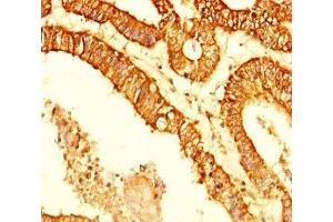 Immunohistochemistry of paraffin-embedded human endometrial cancer using ABIN7158700 at dilution of 1:100 (KDM4C 抗体  (AA 450-600))
