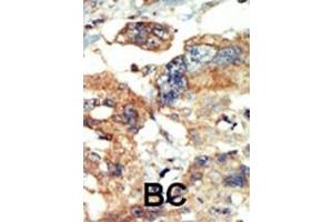 Formalin-fixed and paraffin-embedded human cancer tissue reacted with the primary antibody, which was peroxidase-conjugated to the secondary antibody, followed by AEC staining. (PI4KB 抗体  (N-Term))