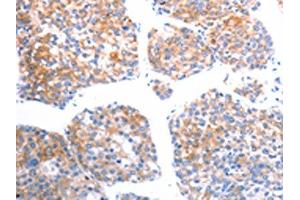 The image on the left is immunohistochemistry of paraffin-embedded Human liver cancer tissue using ABIN7192492(SLC44A1 Antibody) at dilution 1/25, on the right is treated with synthetic peptide. (SLC44A1 抗体)