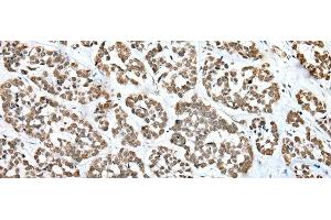 Immunohistochemistry of paraffin-embedded Human esophagus cancer tissue using ZNF486 Polyclonal Antibody at dilution of 1:50(x200) (ZNF486 抗体)
