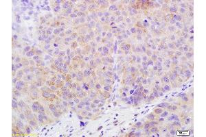 Formalin-fixed and paraffin embedded human bladder carcinoma labeled with Rabbit Anti-Claudin 17 Polyclonal Antibody, Unconjugated  at 1:200 followed by conjugation to the secondary antibody and DAB staining (Claudin 17 抗体  (AA 29-81))