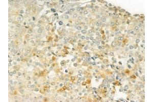 ABIN6266025 and ABIN6277652 at 1/100 staining human prostate carcinoma by IHC-P.