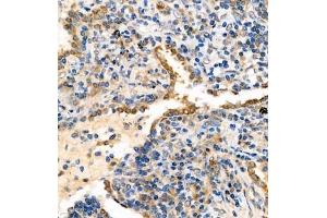 Immunohistochemistry analysis of paraffin embedded human lung cancer using syt1 (ABIN7075794) at dilution of 1: 2000 (SYT1 抗体)