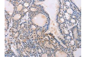 The image on the left is immunohistochemistry of paraffin-embedded Human thyroid cancer tissue using ABIN7130592(PFN4 Antibody) at dilution 1/20, on the right is treated with fusion protein. (Profilin 4 抗体)