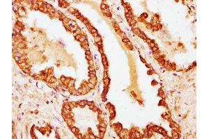 IHC image of ABIN7177373 diluted at 1:100 and staining in paraffin-embedded human prostate cancer performed on a Leica BondTM system. (Cytokeratin 18 抗体  (AA 200-423))