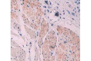 IHC-P analysis of stomach cancer tissue, with DAB staining. (Supervillin 抗体  (AA 1385-1525))