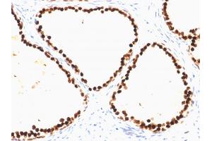 Formalin-fixed, paraffin-embedded human Prostate Carcinoma stained with FOXA1 Mouse Monoclonal Antibody (FOXA1/1515). (FOXA1 抗体  (AA 372-472))