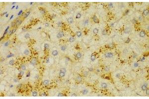 Immunohistochemistry of paraffin-embedded Human liver cancer using ACTN1 Polyclonal Antibody at dilution of 1:100 (40x lens). (ACTN1 抗体)