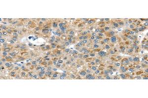 Immunohistochemistry of paraffin-embedded Human liver cancer tissue using USP9X Polyclonal Antibody at dilution 1:40 (USP9X 抗体)