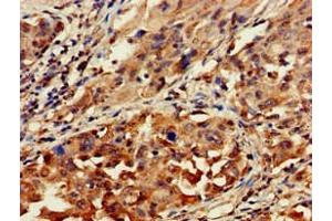 Immunohistochemistry of paraffin-embedded human lung cancer using ABIN7154711 at dilution of 1:100 (GNAT1 抗体  (AA 92-170))