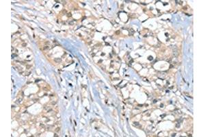 The image on the left is immunohistochemistry of paraffin-embedded Human breast cancer tissue using ABIN7192347(SGPL1 Antibody) at dilution 1/25, on the right is treated with synthetic peptide. (SGPL1 抗体)