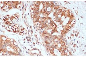 Immunohistochemistry of paraffin-embedded Human mammary cancer using PTPRN2 Polyclonal Antibody at dilution of 1:100 (40x lens). (PTPRN2 抗体)