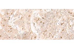 Immunohistochemistry of paraffin-embedded Human esophagus cancer tissue using IL7 Polyclonal Antibody at dilution of 1:30(x200) (IL-7 抗体)