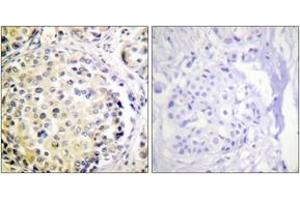 Immunohistochemistry analysis of paraffin-embedded human breast carcinoma tissue, using Vimentin (Ab-56) Antibody. (Vimentin 抗体  (AA 31-80))
