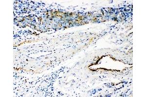 IHC-P: HYAL3 antibody testing of human breast cancer tissue (HYAL3 抗体  (C-Term))