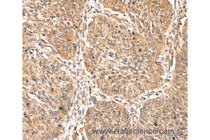 Immunohistochemistry of Human lung cancer using PDLIM4 Polyclonal Antibody at dilution of 1:40 (PDLIM4 抗体)