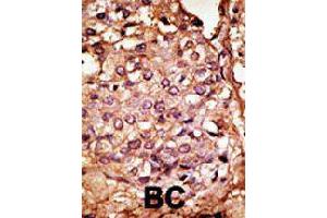 Formalin-fixed and paraffin-embedded human cancer tissue reacted with CCBP2 polyclonal antibody  , which was peroxidase-conjugated to the secondary antibody, followed by AEC staining.