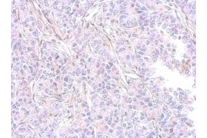 IHC-P Image MMP9 antibody [N2C1], Internal detects MMP9 protein at cytosol on AGS xenograft by immunohistochemical analysis. (MMP 9 抗体)