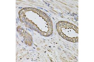 Immunohistochemistry of paraffin-embedded human prostate using S100A12 antibody. (S100A12 抗体  (AA 1-92))
