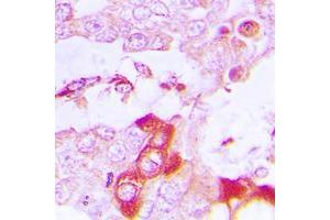 Immunohistochemical analysis of TRAF3IP3 staining in human lung cancer formalin fixed paraffin embedded tissue section. (TRAF3IP3 抗体  (Center))