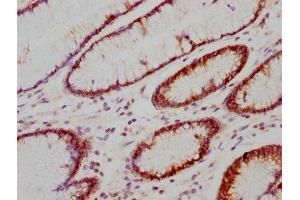 IHC image of ABIN7127380 diluted at 1:118 and staining in paraffin-embedded human gastric cancer performed on a Leica BondTM system. (Recombinant CA9 抗体)