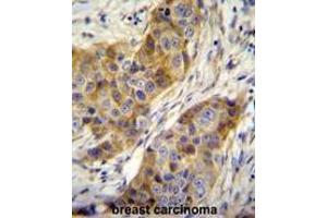ANR39 Antibody (C-term) immunohistochemistry analysis in formalin fixed and paraffin embedded human breast carcinoma followed by peroxidase conjugation of the secondary antibody and DAB staining. (ANKRD39 抗体  (C-Term))