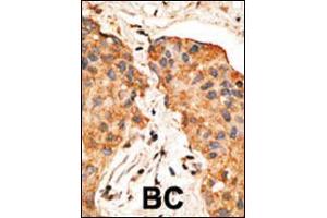 Formalin-fixed and paraffin-embedded human cancer tissue reacted with the primary antibody, which was peroxidase-conjugated to the secondary antibody, followed by DAB staining. (Neuregulin 1 抗体  (AA 198-229))