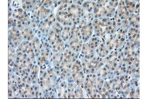 Immunohistochemical staining of paraffin-embedded Adenocarcinoma of Human colon tissue using anti-MIOX mouse monoclonal antibody. (MIOX 抗体)