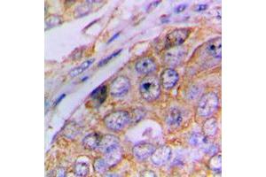 Immunohistochemical analysis of Caspase 4 p20 staining in human lung cancer formalin fixed paraffin embedded tissue section. (Caspase 4 p20 (Center) 抗体)