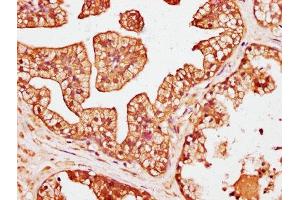 IHC image of ABIN7146454 diluted at 1:200 and staining in paraffin-embedded human prostate cancer performed on a Leica BondTM system. (Calcyphosine 抗体  (AA 1-189))