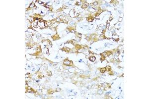 Immunohistochemistry of paraffin-embedded human liver cancer using Alpha-1 Antichymotrypsin (Alpha-1 Antichymotrypsin (SERPIN)) antibody (ABIN3016733, ABIN3016734, ABIN3016735 and ABIN6219829) at dilution of 1:100 (40x lens). (SERPINA3 抗体  (AA 24-423))
