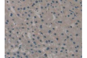 Detection of ATP1b3 in Human Liver cancer Tissue using Polyclonal Antibody to Sodium/potassium Transporting ATPase Subunit Beta-3 (ATP1b3)