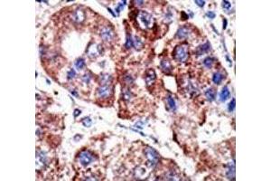 IHC analysis of FFPE human hepatocarcinoma tissue stained with the p62 antibody (SQSTM1 抗体  (AA 317-346))