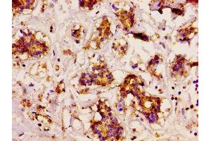 IHC image of ABIN7150414 diluted at 1:200 and staining in paraffin-embedded human breast cancer performed on a Leica BondTM system. (CD3EAP 抗体  (AA 289-404))
